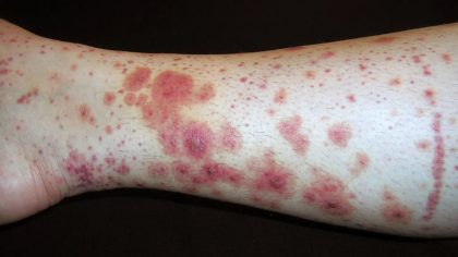 Purpura : types, symptômes et traitement