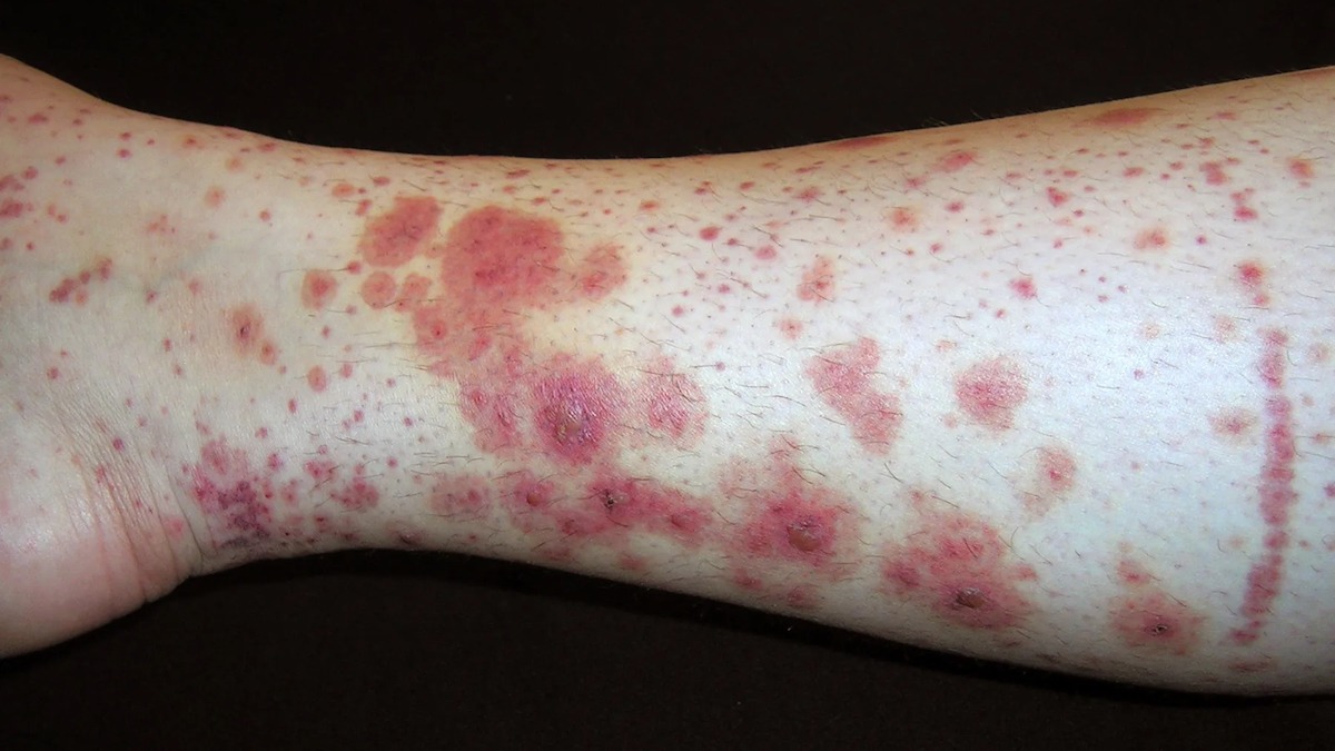 Purpura : types, symptômes et traitement