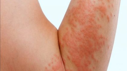 Qu'est-ce que la gale ? Causes, symptômes et traitement