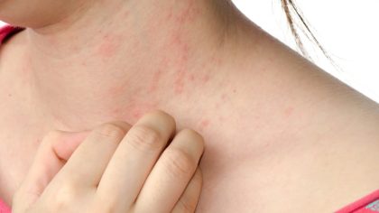 Qu’est-ce qu’une allergie aux acariens et comment peut-elle être évitée ?