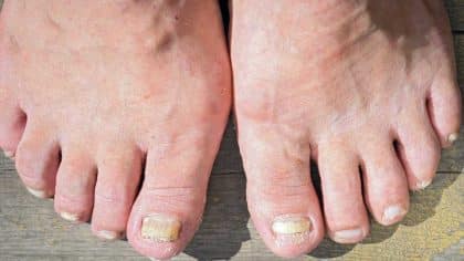 Remède de grand-mère pour éliminer les ongles épais et rugueux
