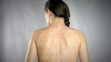 Rougeole : symptômes et causes
