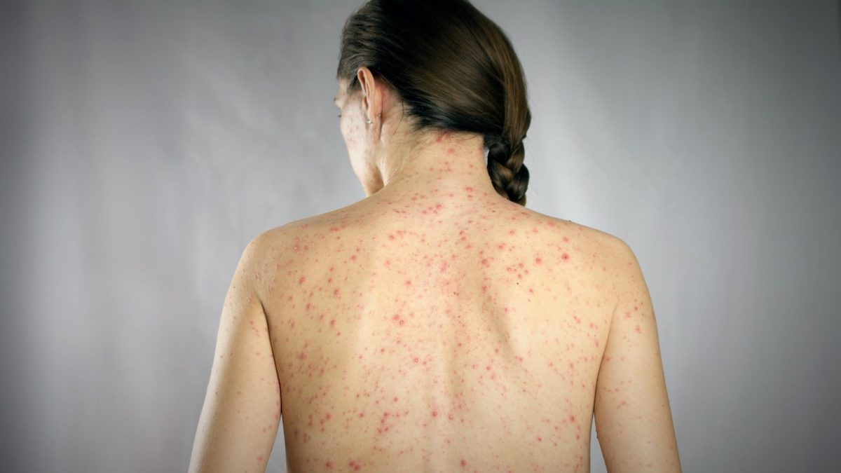 Rougeole : symptômes et causes