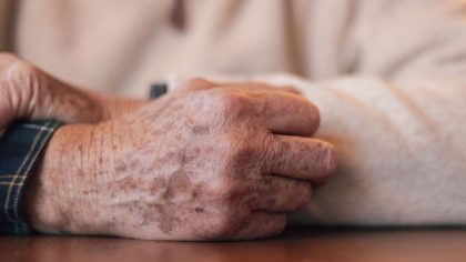 Taches sur les mains : types, causes et traitements