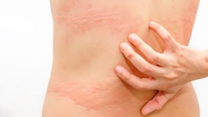 Urticaire et œdème de Quincke : diagnostic, symptômes et traitement