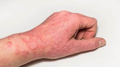 Urticaire et œdème de Quincke : diagnostic, symptômes et traitement