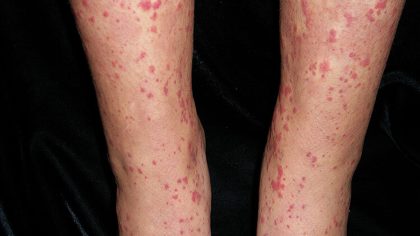 Vascularite : symptômes et causes