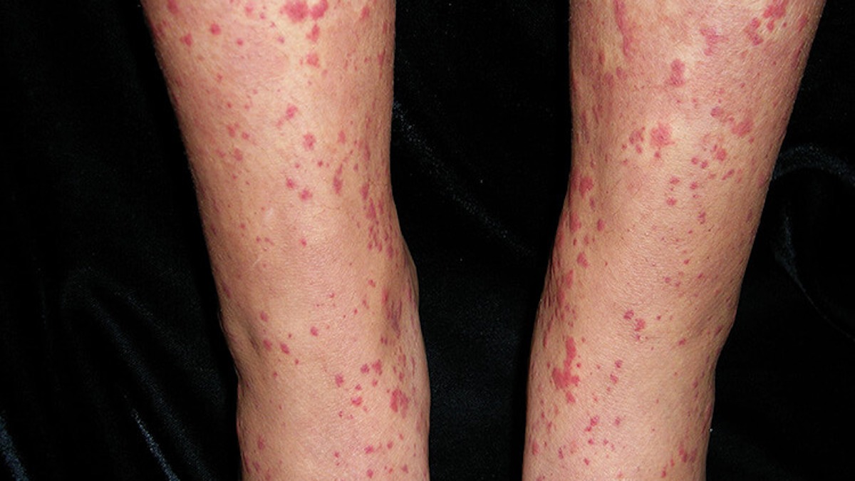 Vascularite : symptômes et causes