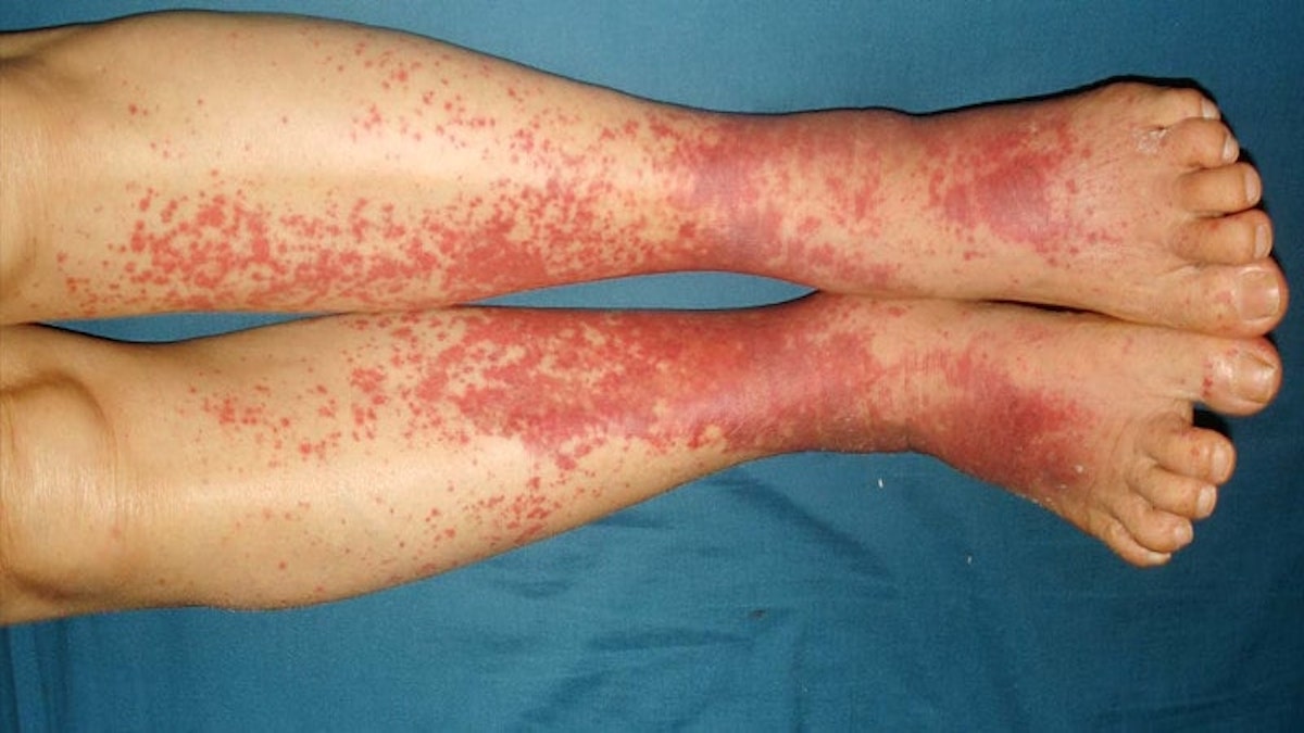 Vascularite : symptômes et causes