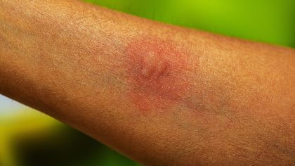 À quoi ressemble le moustique de la dengue ? Découvrez ces 4 conseils pour le différencier du moustique commun.