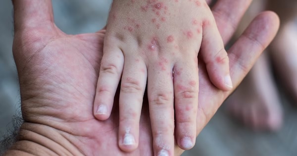 Alerte : la maladie de Coxsackie, comment se transmet-elle ?