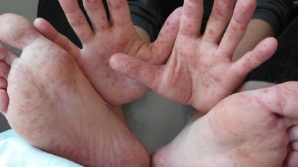 Alerte : la maladie de Coxsackie, comment se transmet-elle ?