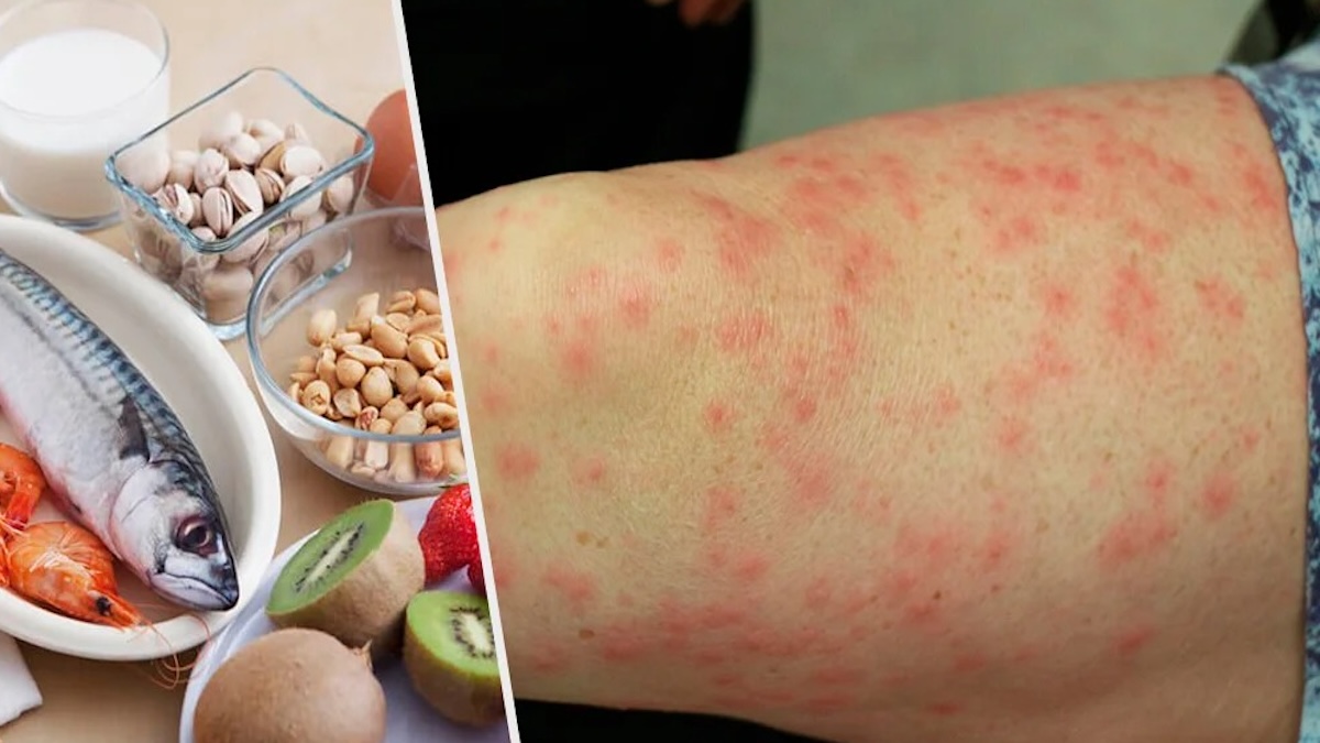 Quels sont les aliments allergènes les plus courants et comment éviter qu’ils ne nous nuisent ?