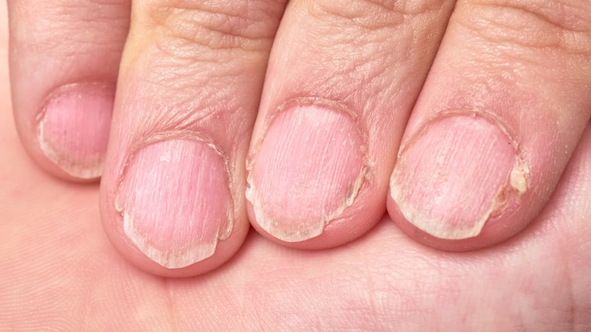Ongles à rayures verticales, un avertissement du corps sur votre état de santé