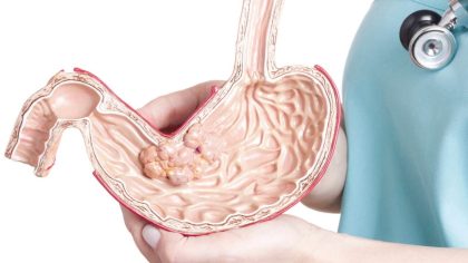 Quels sont les facteurs de risque du cancer de l’estomac ?