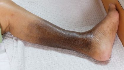 Coloration à l'hémosidérine : pourquoi les jambes brunissent-elles ?