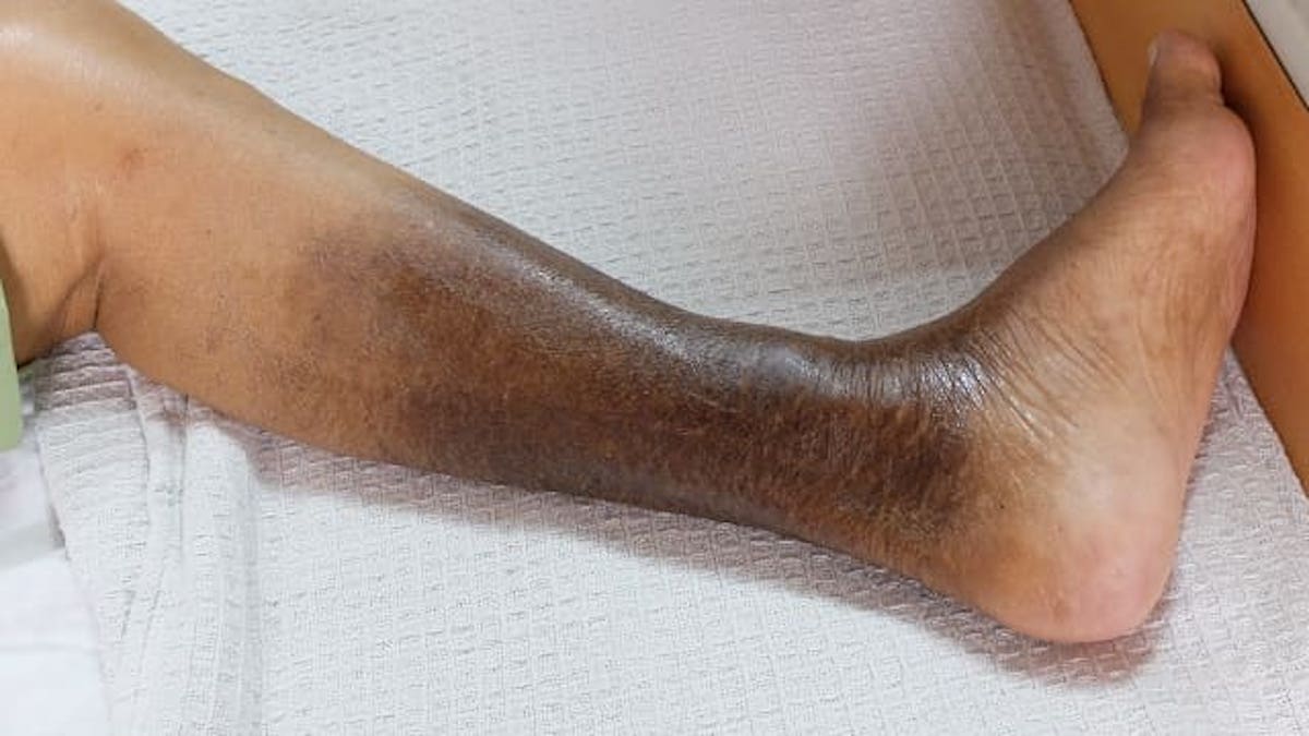 Coloration à l'hémosidérine : pourquoi les jambes brunissent-elles ?