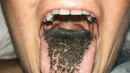 Ce ne sont pas des « poils » qui poussent sur la langue, mais les papilles de la langue qui s'allongent en raison de l'accumulation de cellules mortes de la peau, formant ce que l'on appelle la langue velue ou poilue