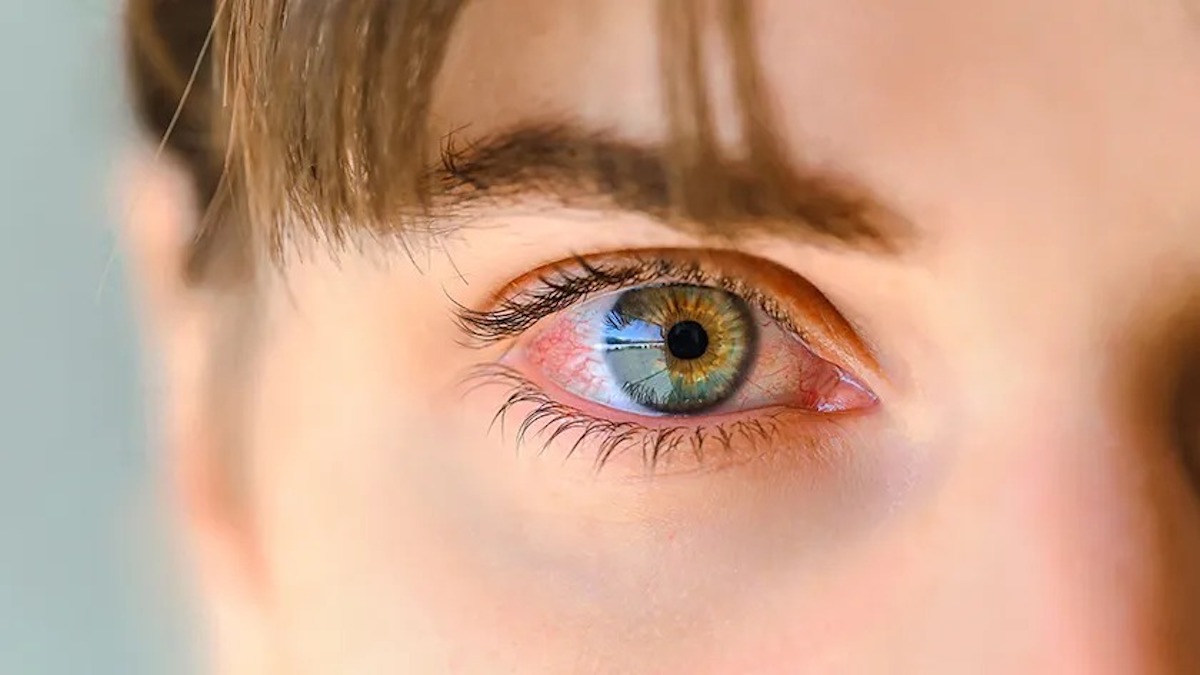 Conjonctivite : symptômes, causes et solutions efficaces pour éviter la propagation et soulager les yeux