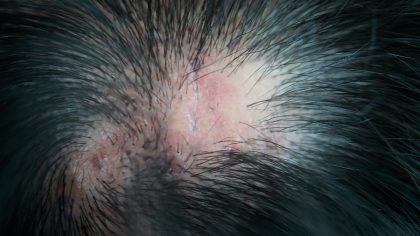 Cuir chevelu brûlé : comment le traiter en toute sécurité