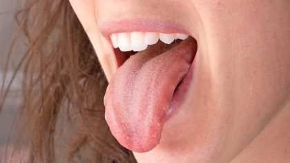 Des bosses sur la langue : quand faut-il s'inquiéter ?