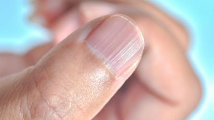 Des lignes et des sillons sur les ongles : ce qu’ils révèlent sur votre santé