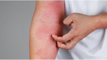 Eczéma : des traitements vraiment efficaces, ça existe ?