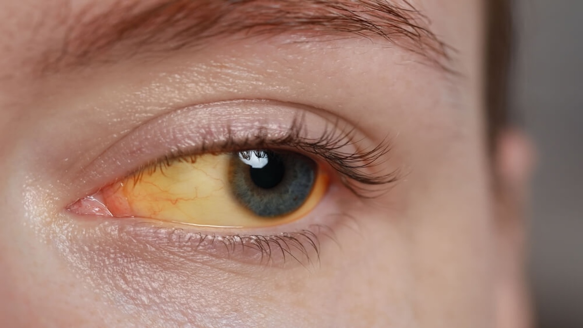 La principale raison pour laquelle les yeux deviennent jaunes, vous devez être prudent
