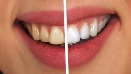 Le secret naturel pour des dents plus blanches : et il se trouve dans votre cuisine !