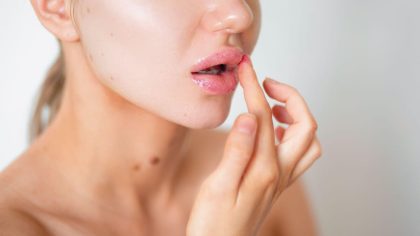 Les cloques dans la bouche peuvent être le signe de plusieurs maladies, en plus de l’herpès