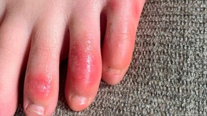 Les doigts de COVID : quand le virus touche la peau