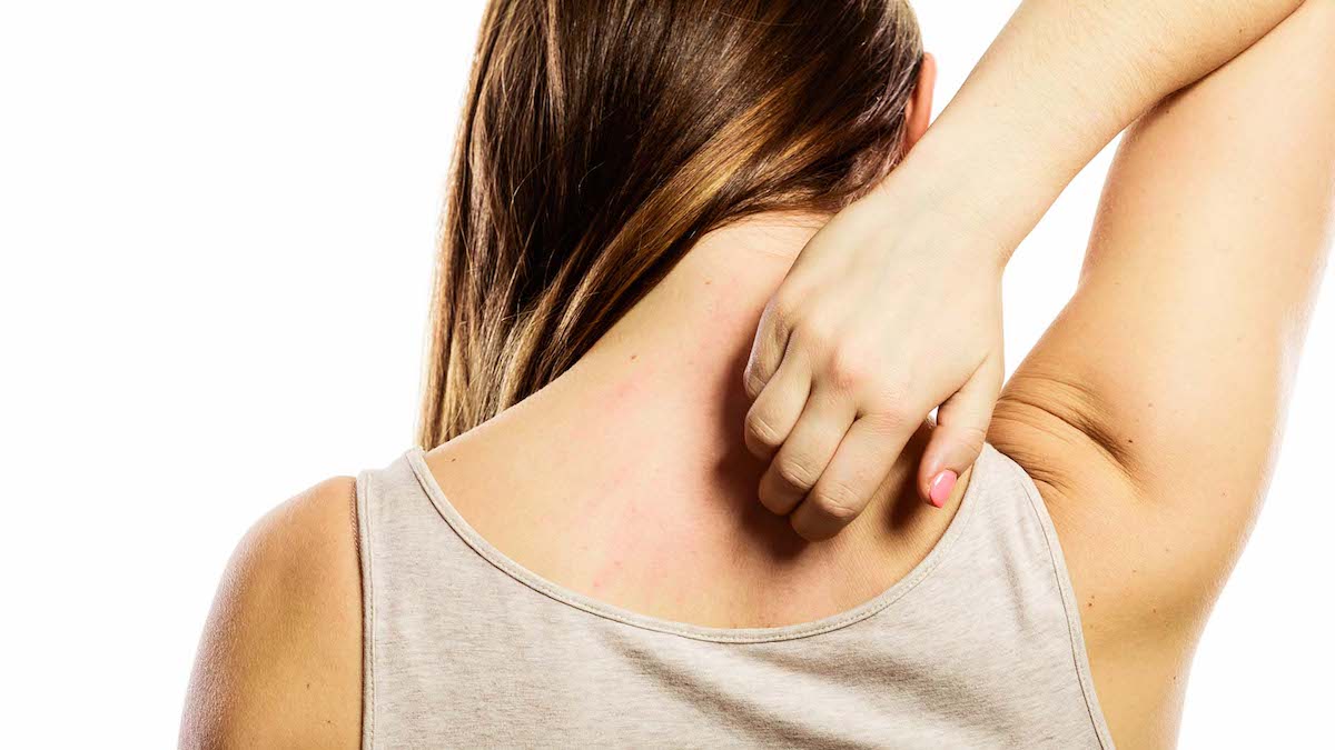 Les pellicules, la dermatite séborrhéique et le psoriasis peuvent s’aggraver pendant les mois d’été