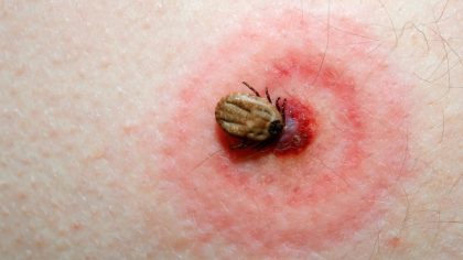 Maladies transmises par les tiques et comment les retirer lorsqu’elles s’accrochent à la peau humaine