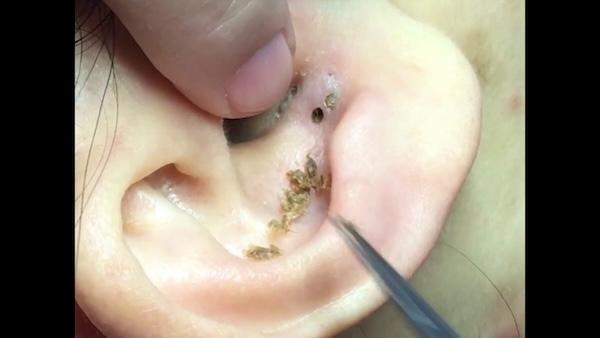 Marie avait ce point noir près de l'oreille depuis 50 ans. quand ils l'ont retiré, ils ont découvert tout ce qu'il y avait à l'intérieur