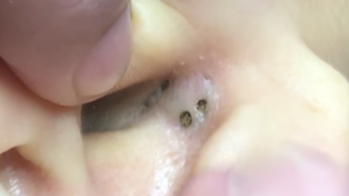 Marie avait ce point noir près de l'oreille depuis 50 ans. quand ils l'ont retiré, ils ont découvert tout ce qu'il y avait à l'intérieur