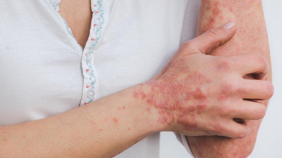 Miliaria : causes, symptômes et comment la traiter efficacement
