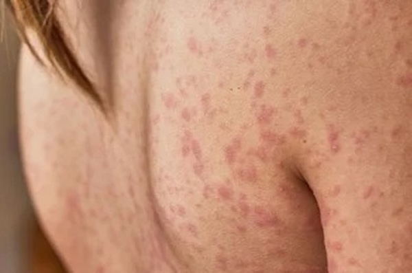 Miliaria : causes, symptômes et comment la traiter efficacement
