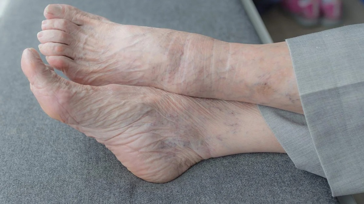 Pieds gonflés : ce que cache ce symptôme et comment le soulager à la maison