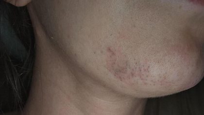 Pourquoi les femmes ont-elles des poils sur le menton ?