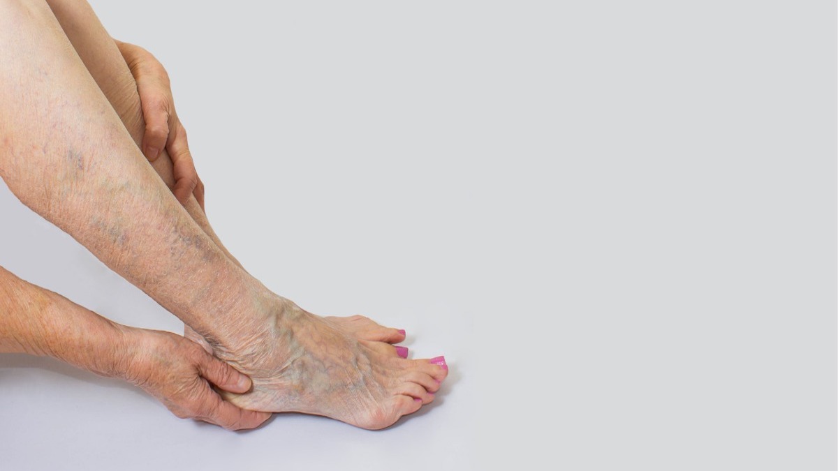 Veines gonflées aux pieds : causes possibles et solutions