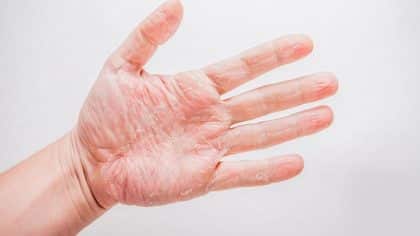 Pourquoi nos mains pèlent-elles vraiment ? Causes cachées et astuces simples pour les éviter