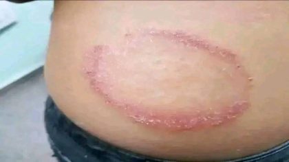 Qu’est-ce que la teigne, comment se transmet-elle et que faire si vous êtes infecté ?