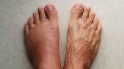 Signes sur vos pieds indiquant que votre rein est malade