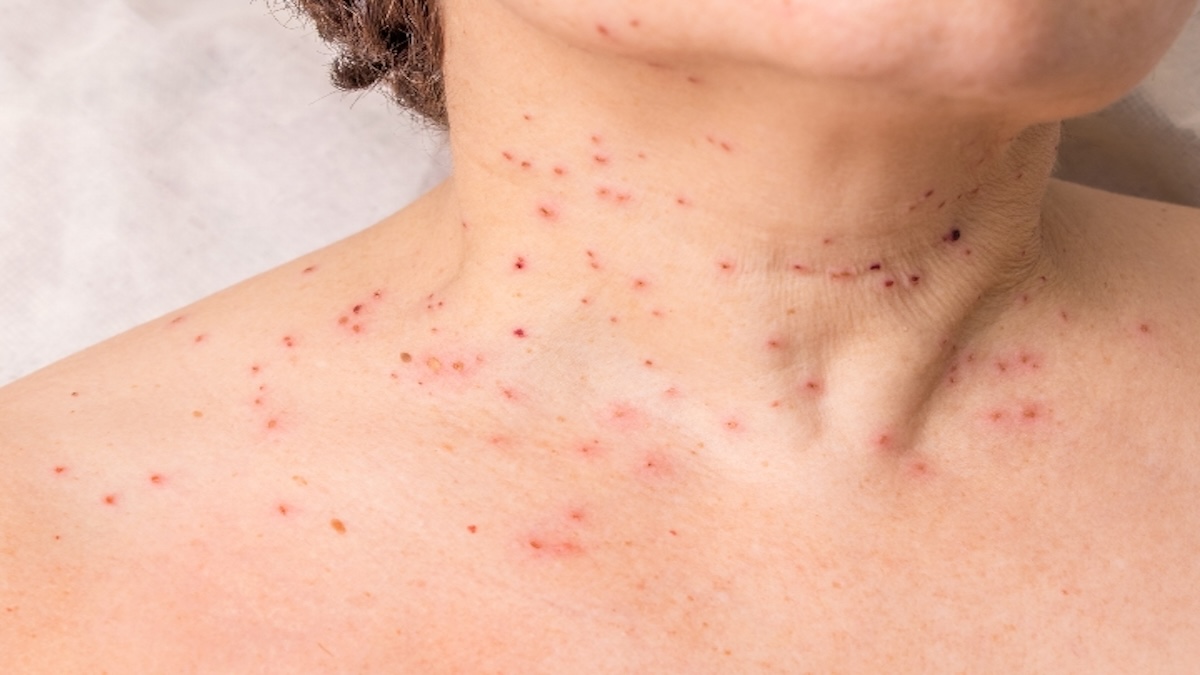 Soyez attentif à votre corps ; ces taches rouges sur votre peau peuvent être le signe d'une maladie grave