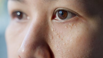 Soyez vigilant si vous voyez ces petites bosses blanches sur votre peau, Voici pourquoi