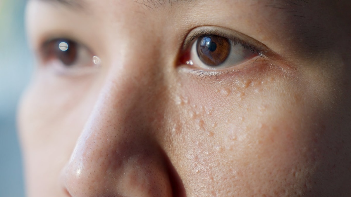 Soyez vigilant si vous voyez ces petites bosses blanches sur votre peau, Voici pourquoi
