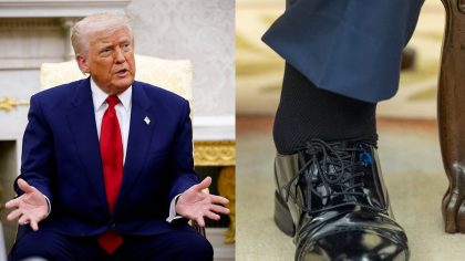 Trump souffre d’une maladie chronique qui explique pourquoi il a des ecchymoses sur les mains et des chevilles enflées