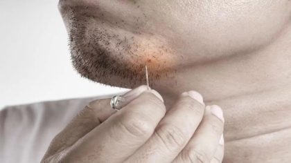 Un poil incarné mal retiré transforme la vie d’un homme en cauchemar médical