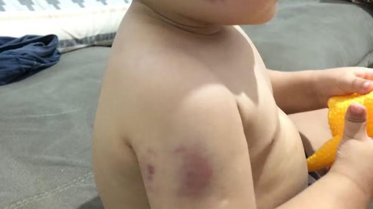 Une mère découvre une morsure sur la main de son fils : un mystère terrifiant