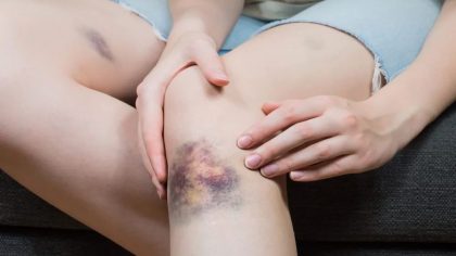 Voici la véritable raison pour laquelle nous avons souvent des ecchymoses. La réponse pourrait vous surprendre